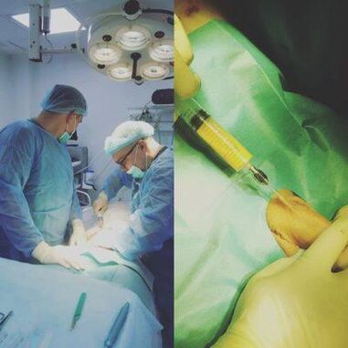 It is possible to thicken the penis with surgical intervention