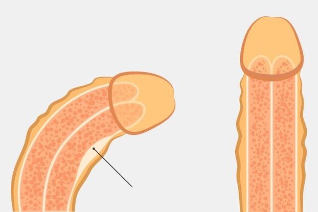 An effective way to straighten the penis
